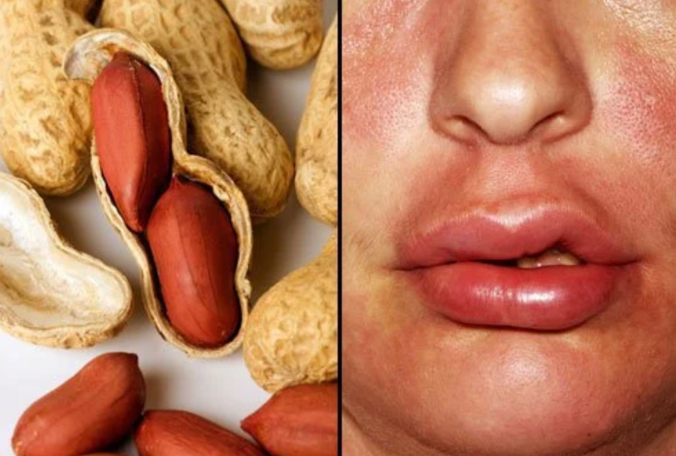 Anaphylaxis and Food Allergy