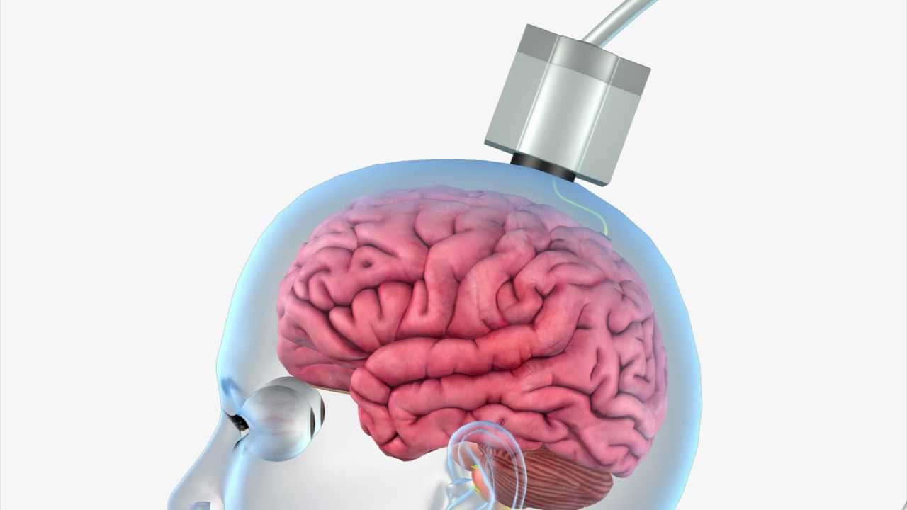 Introduction to BrainGate